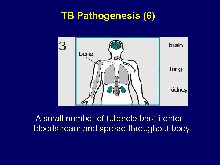 TB Pathogenesis (6) A small number of tubercle bacilli enter bloodstream and spread throughout