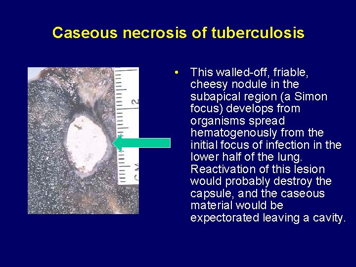 Caseous necrosis of tuberculosis • This walled-off, friable, cheesy nodule in the subapical region