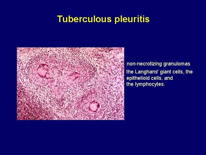 Tuberculous pleuritis non-necrotizing granulomas the Langhans' giant cells, the epithelioid cells, and the lymphocytes.