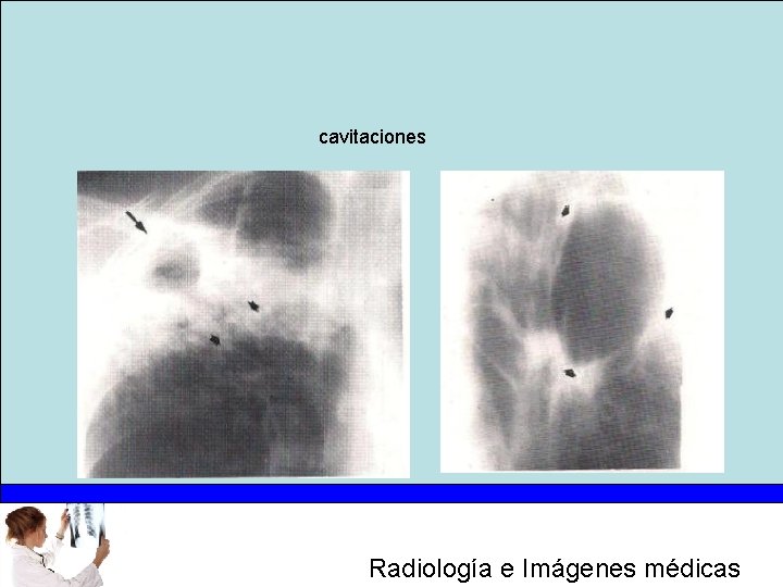 cavitaciones Radiología e Imágenes médicas 