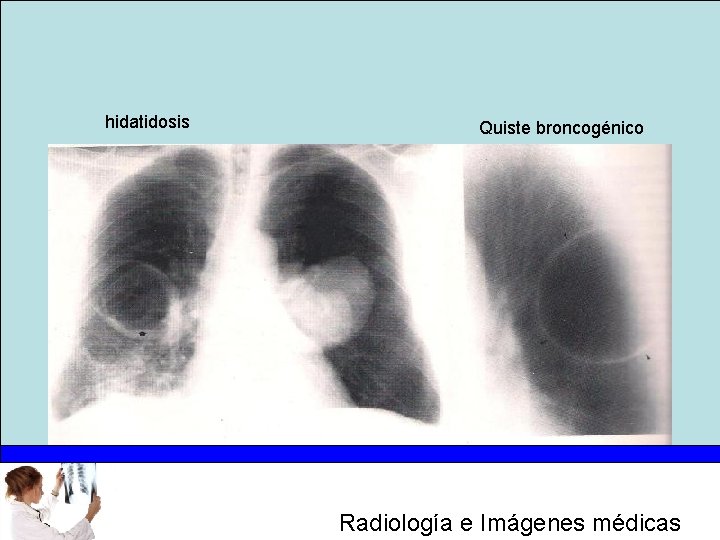 hidatidosis Quiste broncogénico Radiología e Imágenes médicas 