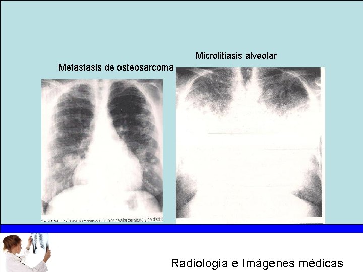 Microlitiasis alveolar Metastasis de osteosarcoma Radiología e Imágenes médicas 