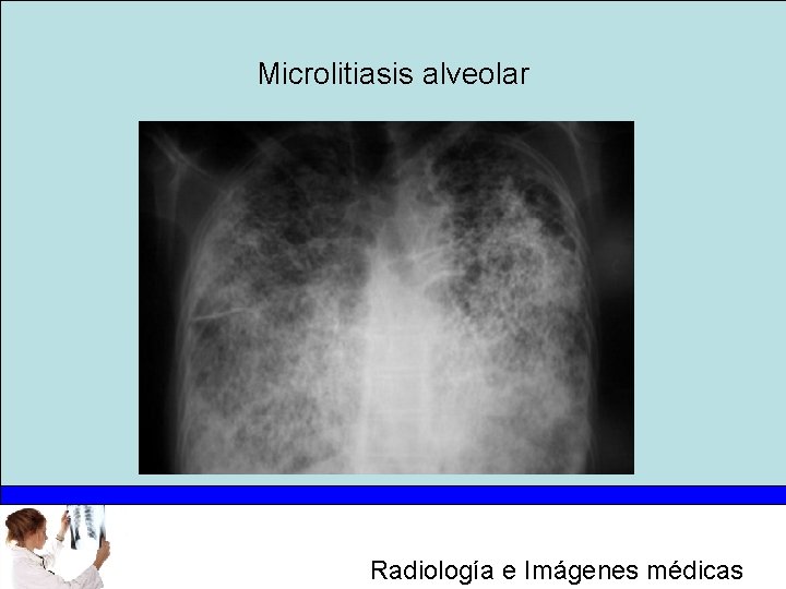 Microlitiasis alveolar Radiología e Imágenes médicas 