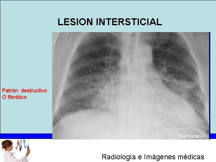 LESION INTERSTICIAL Patrón destructivo O fibrótico Radiología e Imágenes médicas 