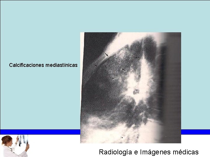 Calcificaciones mediastínicas Radiología e Imágenes médicas 