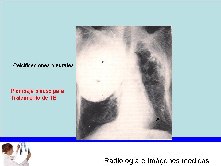 Calcificaciones pleurales Plombaje oleoso para Tratamiento de TB Radiología e Imágenes médicas 