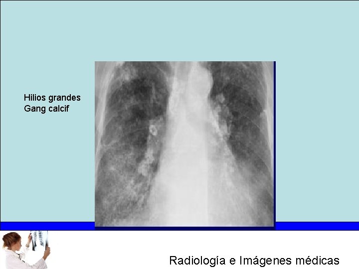 Hilios grandes Gang calcif Radiología e Imágenes médicas 