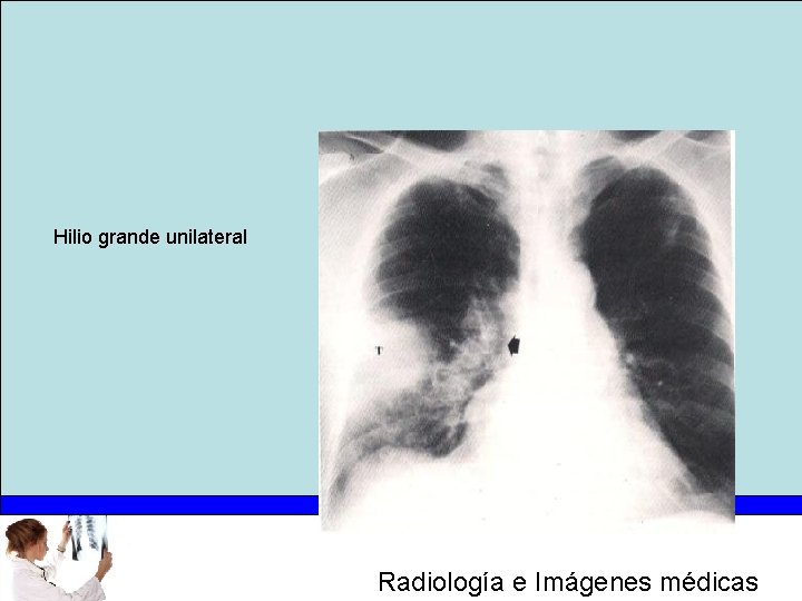 Hilio grande unilateral Radiología e Imágenes médicas 