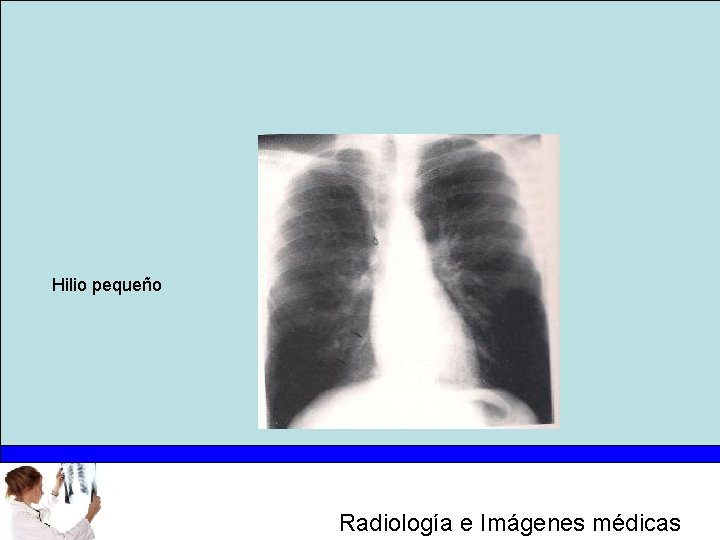 Hilio pequeño Radiología e Imágenes médicas 