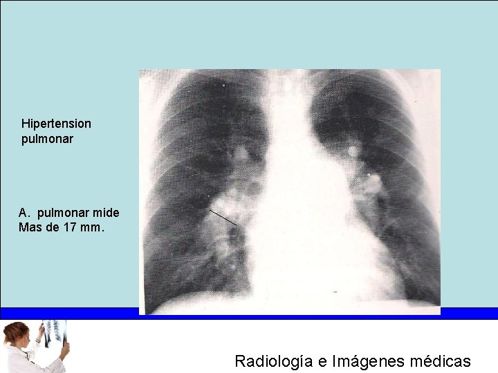 Hipertension pulmonar A. pulmonar mide Mas de 17 mm. Radiología e Imágenes médicas 