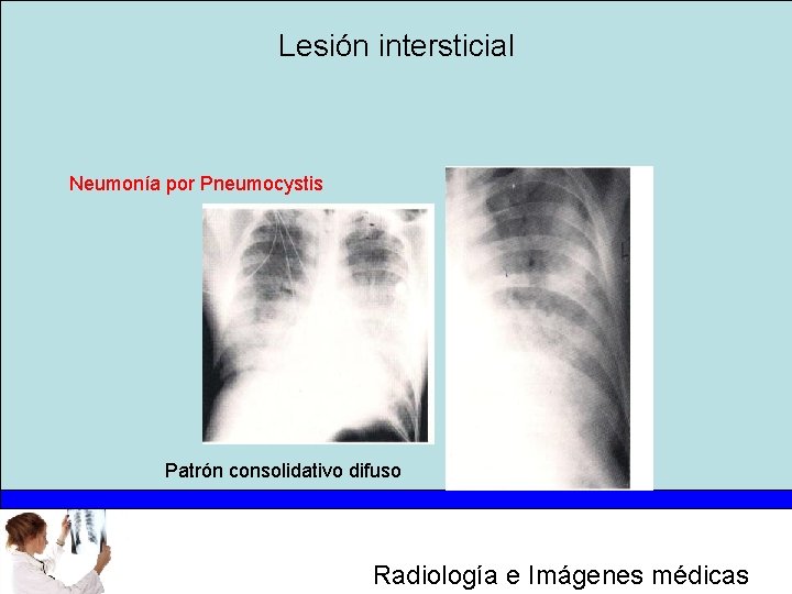 Lesión intersticial Neumonía por Pneumocystis Patrón consolidativo difuso Radiología e Imágenes médicas 