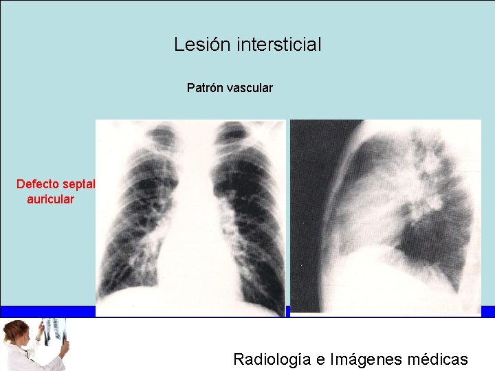 Lesión intersticial Patrón vascular Defecto septal auricular Radiología e Imágenes médicas 