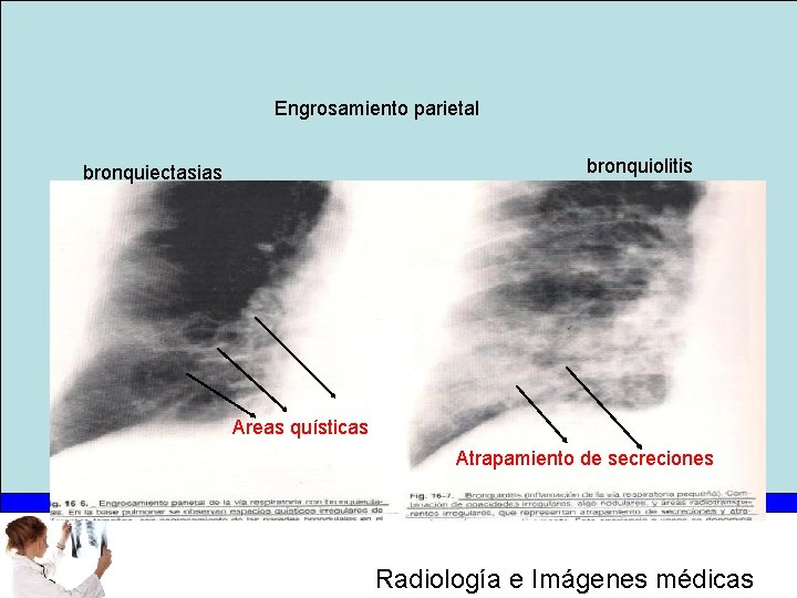 Engrosamiento parietal bronquiolitis bronquiectasias Areas quísticas Atrapamiento de secreciones Radiología e Imágenes médicas 