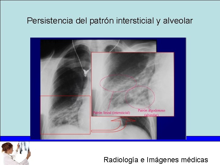 Persistencia del patrón intersticial y alveolar Radiología e Imágenes médicas 