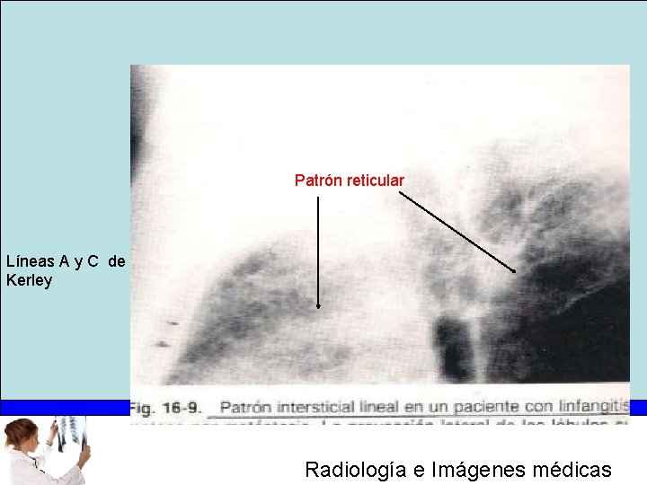 Patrón reticular Líneas A y C de Kerley Radiología e Imágenes médicas 
