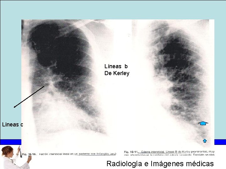 Líneas b De Kerley Lineas c Radiología e Imágenes médicas 