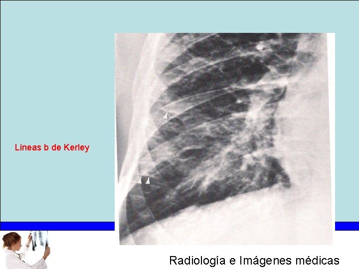Lineas b de Kerley Radiología e Imágenes médicas 