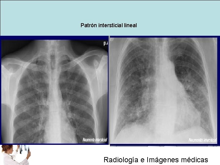 Patrón intersticial lineal Radiología e Imágenes médicas 