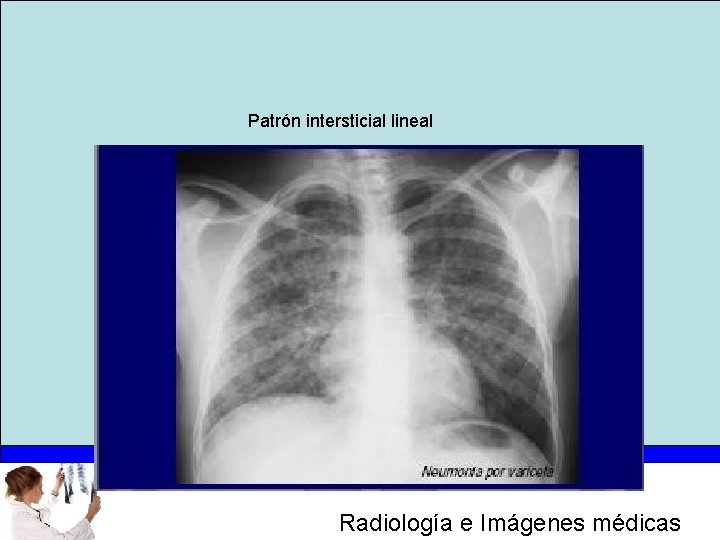 Patrón intersticial lineal Radiología e Imágenes médicas 