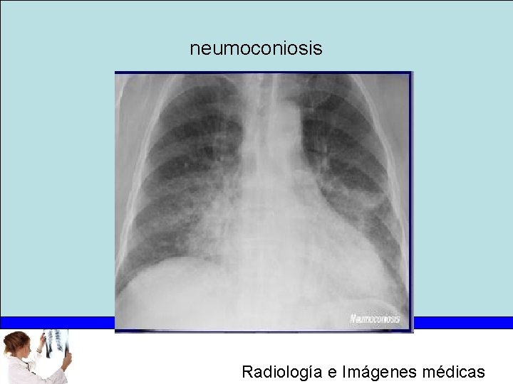 neumoconiosis Radiología e Imágenes médicas 