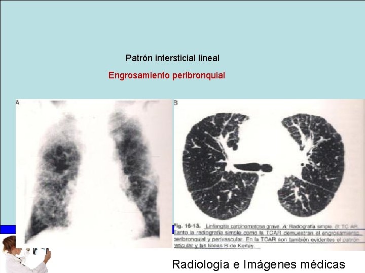 Patrón intersticial lineal Engrosamiento peribronquial Radiología e Imágenes médicas 