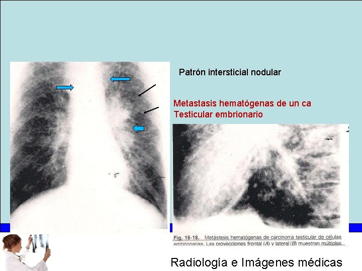 Patrón intersticial nodular Metastasis hematógenas de un ca Testicular embrionario Radiología e Imágenes médicas