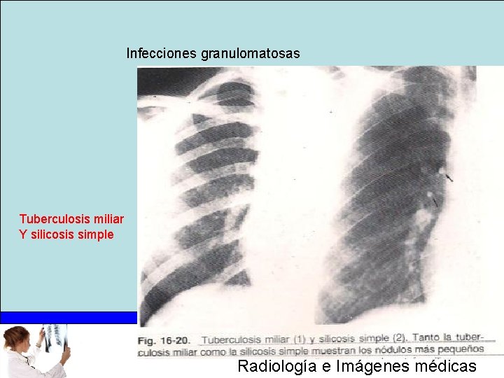 Infecciones granulomatosas Tuberculosis miliar Y silicosis simple Radiología e Imágenes médicas 