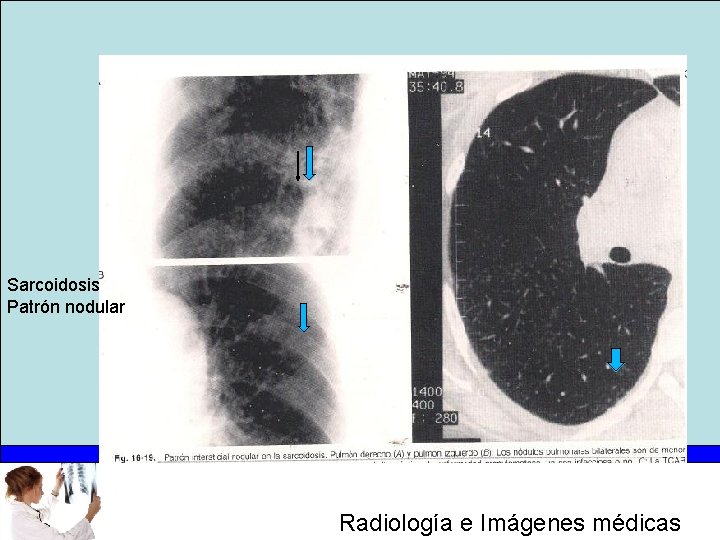 Sarcoidosis Patrón nodular Radiología e Imágenes médicas 