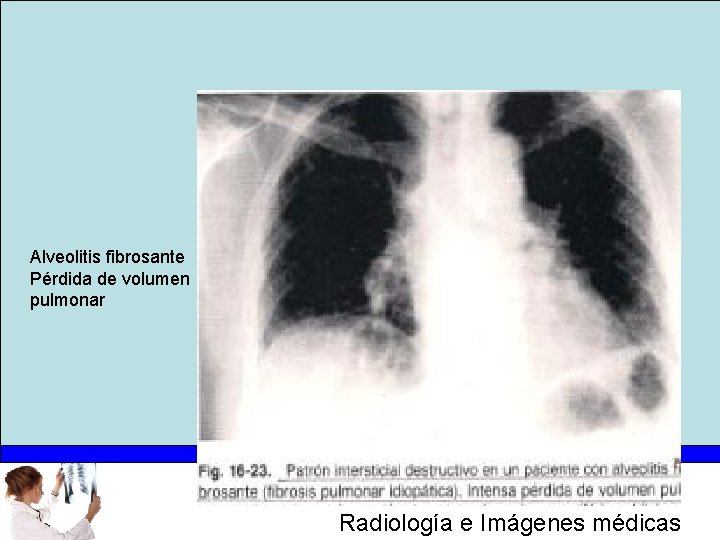Alveolitis fibrosante Pérdida de volumen pulmonar Radiología e Imágenes médicas 