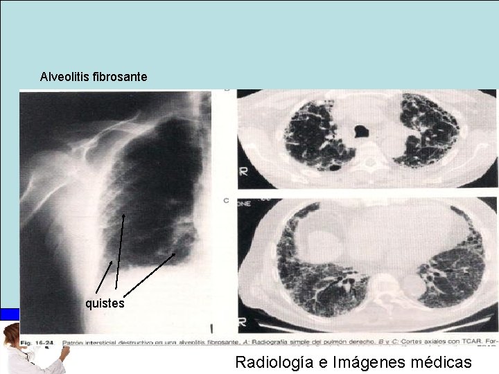 Alveolitis fibrosante quistes Radiología e Imágenes médicas 