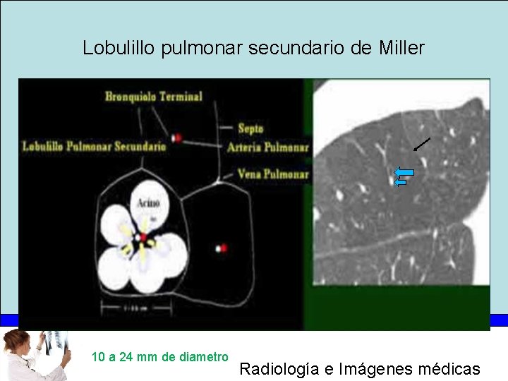 Lobulillo pulmonar secundario de Miller 10 a 24 mm de diametro Radiología e Imágenes