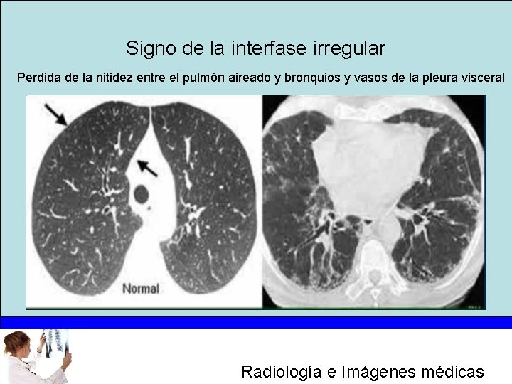 Signo de la interfase irregular Perdida de la nitidez entre el pulmón aireado y