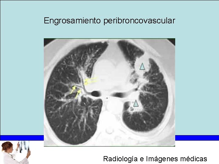 Engrosamiento peribroncovascular Radiología e Imágenes médicas 