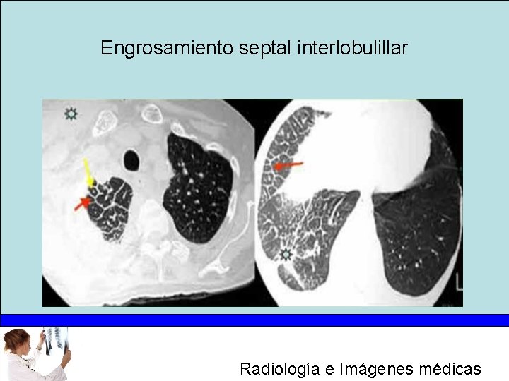Engrosamiento septal interlobulillar Radiología e Imágenes médicas 