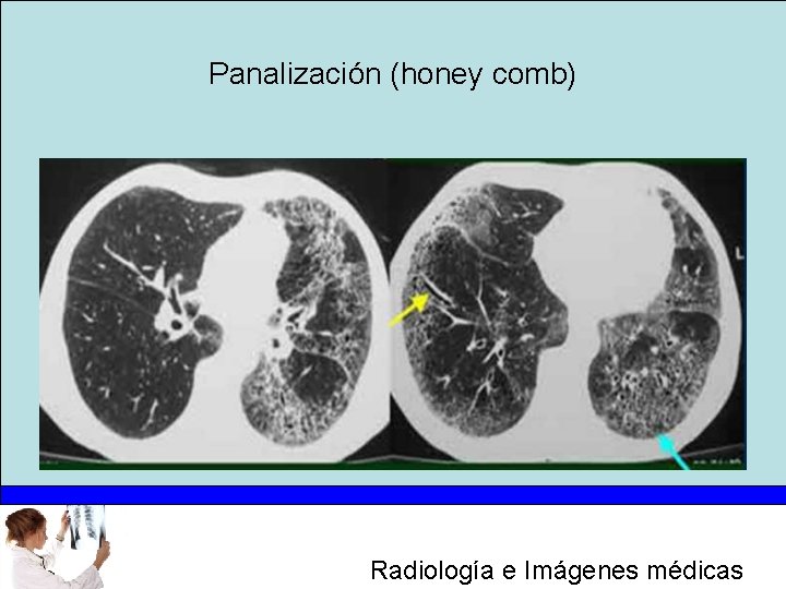 Panalización (honey comb) Radiología e Imágenes médicas 