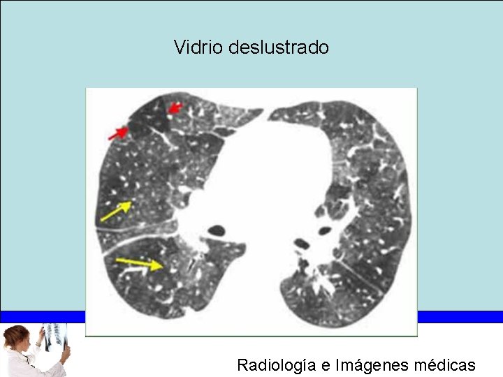 Vidrio deslustrado Radiología e Imágenes médicas 
