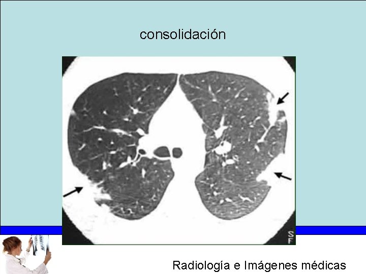 consolidación Radiología e Imágenes médicas 