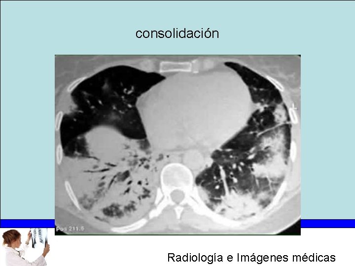 consolidación Radiología e Imágenes médicas 