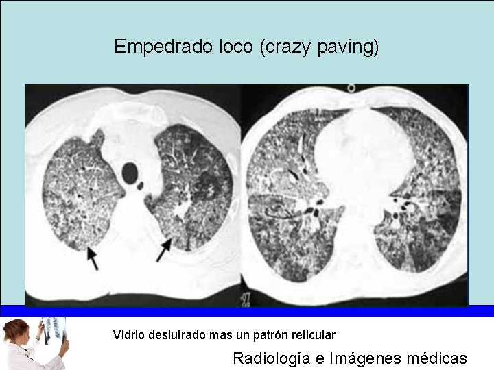 Empedrado loco (crazy paving) Vidrio deslutrado mas un patrón reticular Radiología e Imágenes médicas