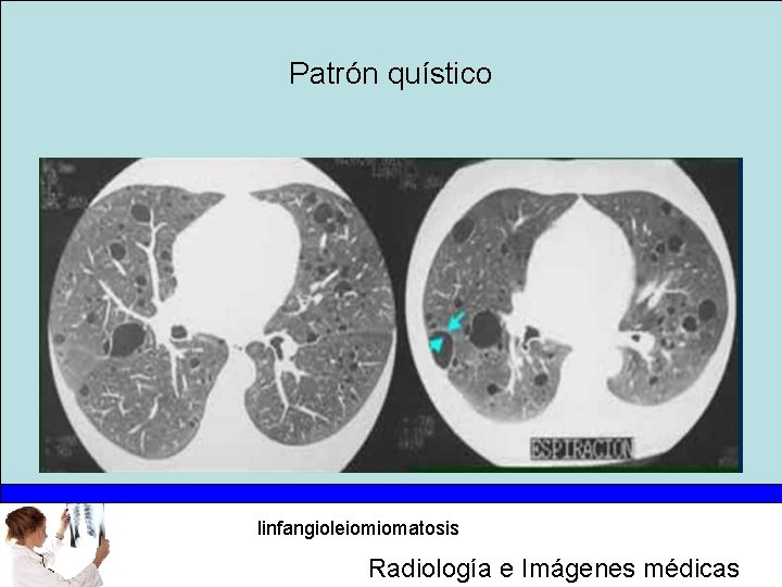 Patrón quístico linfangioleiomiomatosis Radiología e Imágenes médicas 