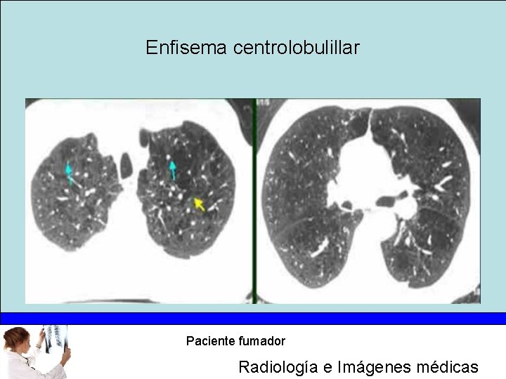 Enfisema centrolobulillar Paciente fumador Radiología e Imágenes médicas 
