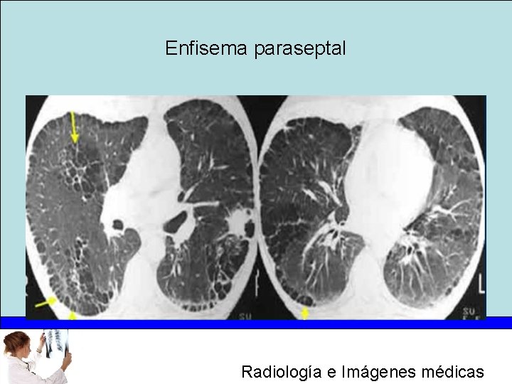 Enfisema paraseptal Radiología e Imágenes médicas 