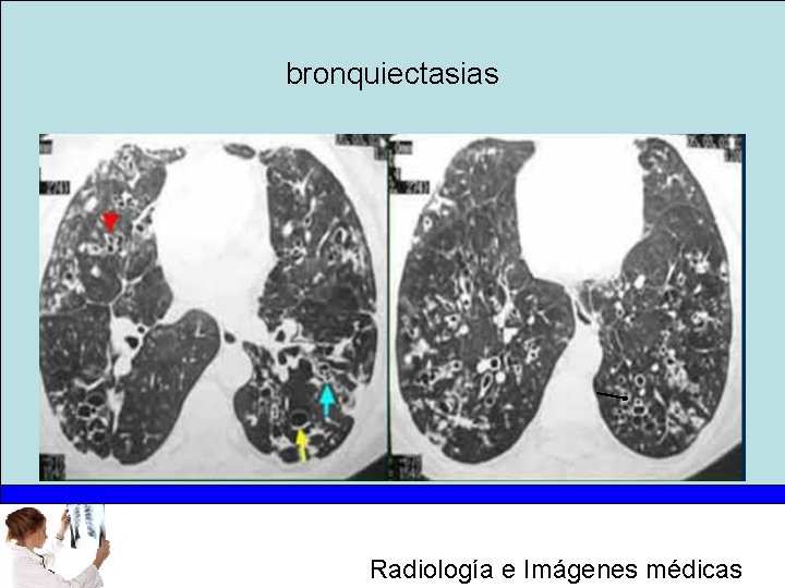 bronquiectasias Radiología e Imágenes médicas 