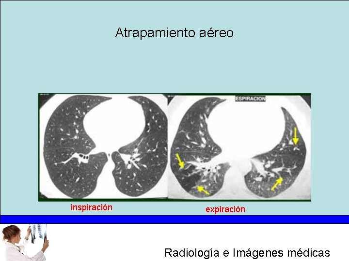 Atrapamiento aéreo inspiración expiración Radiología e Imágenes médicas 