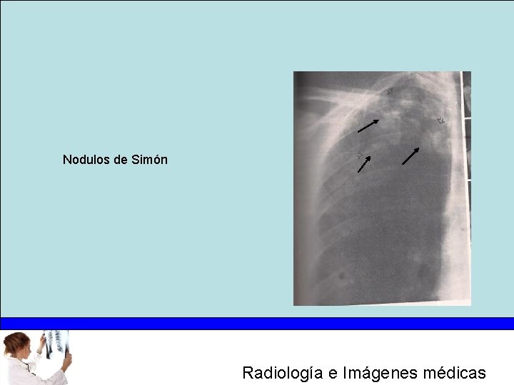 Nodulos de Simón Radiología e Imágenes médicas 