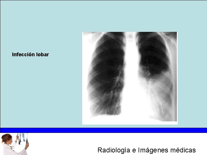 Infección lobar Radiología e Imágenes médicas 