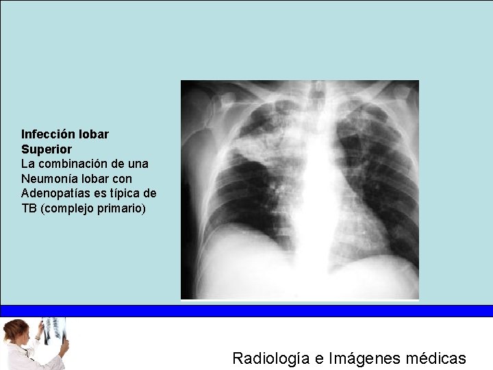 Infección lobar Superior La combinación de una Neumonía lobar con Adenopatías es típica de