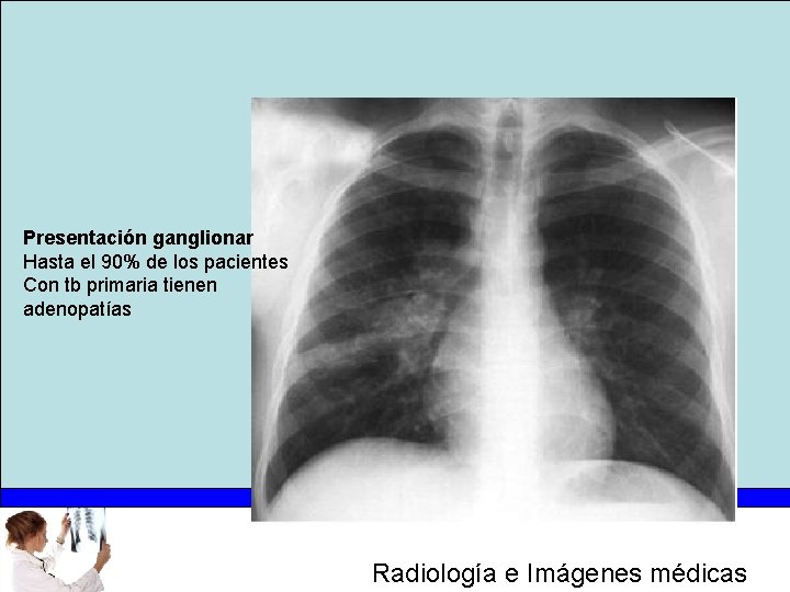 Presentación ganglionar Hasta el 90% de los pacientes Con tb primaria tienen adenopatías Radiología