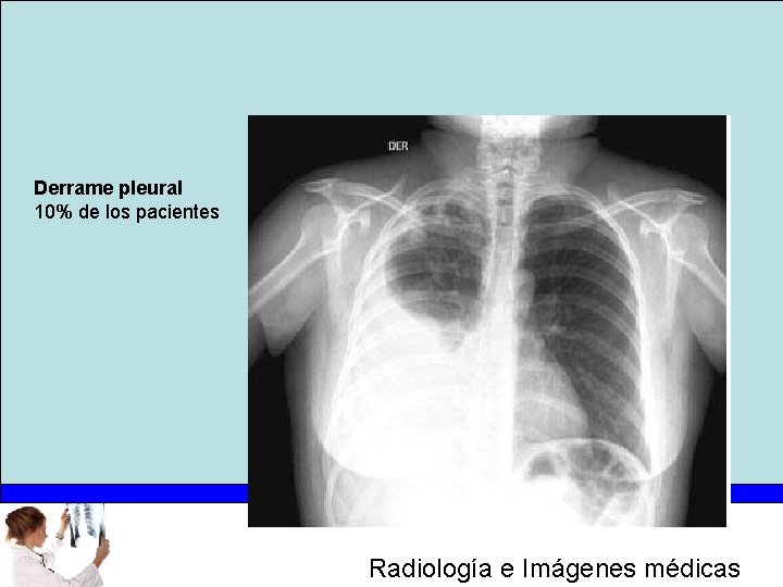 Derrame pleural 10% de los pacientes Radiología e Imágenes médicas 