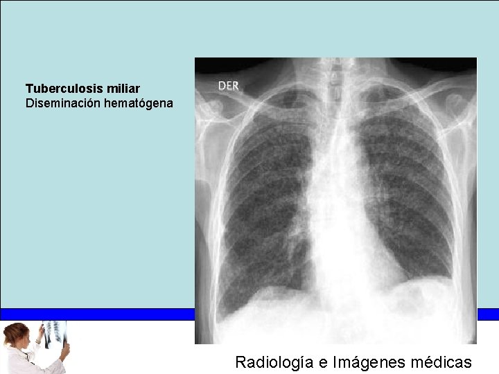 Tuberculosis miliar Diseminación hematógena Radiología e Imágenes médicas 